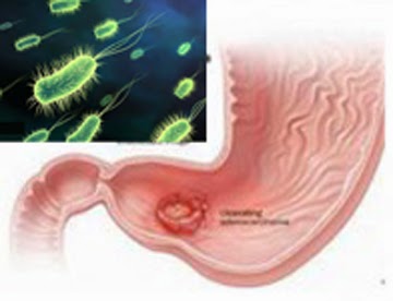 Một số hiểu biết về vi khuẩn Helicobacter pylori